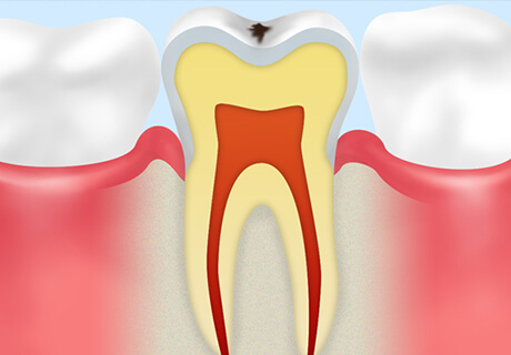 【CO】初期のむし歯