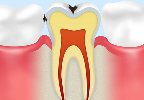 【C1】エナメル質のむし歯
