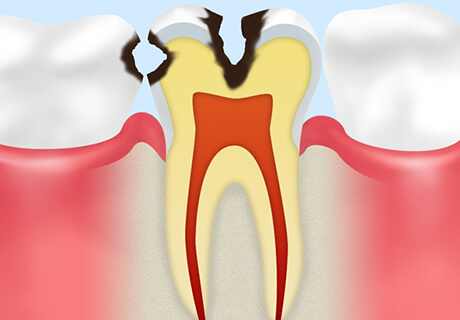 【C2】象牙質のむし歯