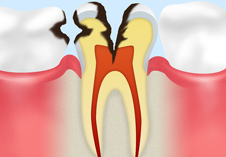 【C3】歯の神経に達したむし歯
