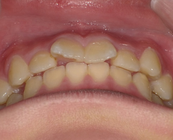 上の前歯の突出感と凸凹