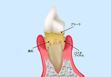 歯周病とは？