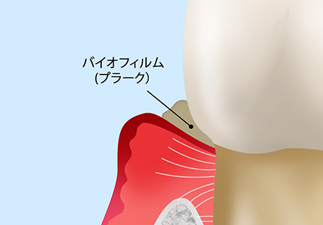 軽度の歯周炎