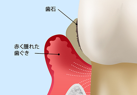 中等度の歯周炎