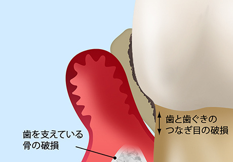 重度の歯周炎