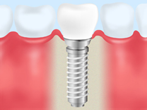 インプラント本体の埋入手術費用（人工歯根）