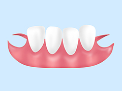 ノンクラスプ義歯