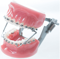 一般的な矯正（メタルブラケット矯正）