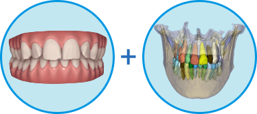 CTスキャンしたデータから歯牙、歯根および歯槽骨を検出して、アイテロでスキャンしたデータを統合させます
