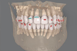 歯冠、歯根および歯槽骨を1つの3Dモデルとして視覚化でき、より精密な治療計画の立案が可能に